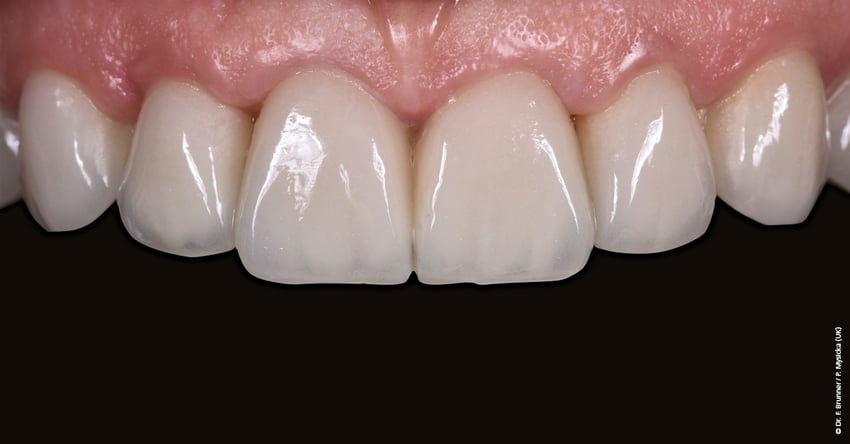 El sistema de cerÃ¡mica sin metal IPS e.max ofrece una amplia gama de opciones para adaptarse a la complejidad del diente natural