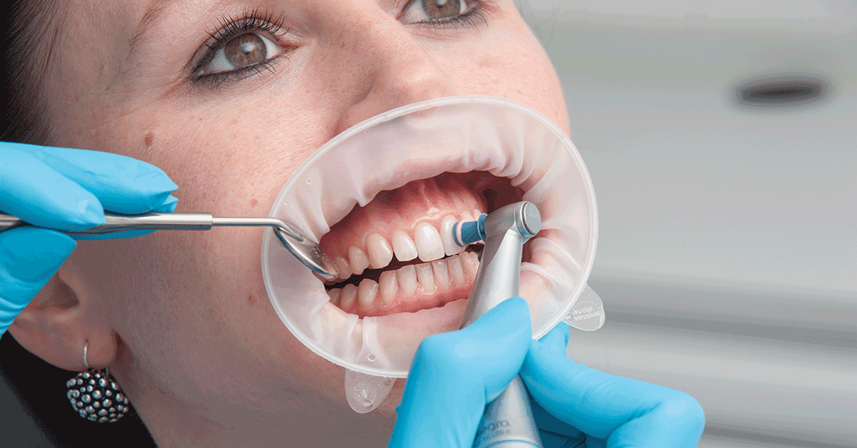 Сколько чистка зубов по времени у стоматолога. Профессиональная гигиена. Механическая чистка зубов. Профессиональная гигиена рта. Профессиональная чистка зубов.